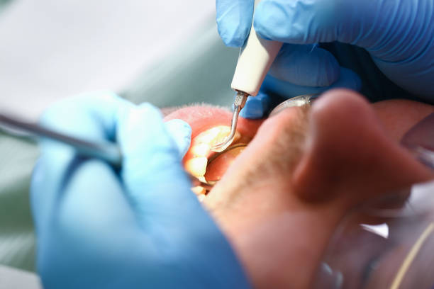 Best Emergency Wisdom Teeth Removal in Moody Af, GA