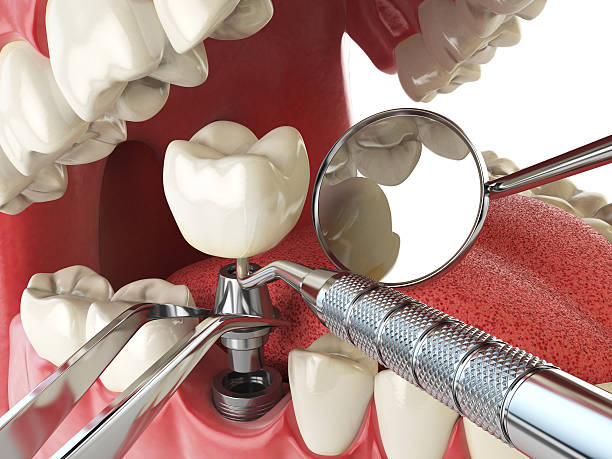 Best Emergency Root Canal Treatment in Moody Af, GA
